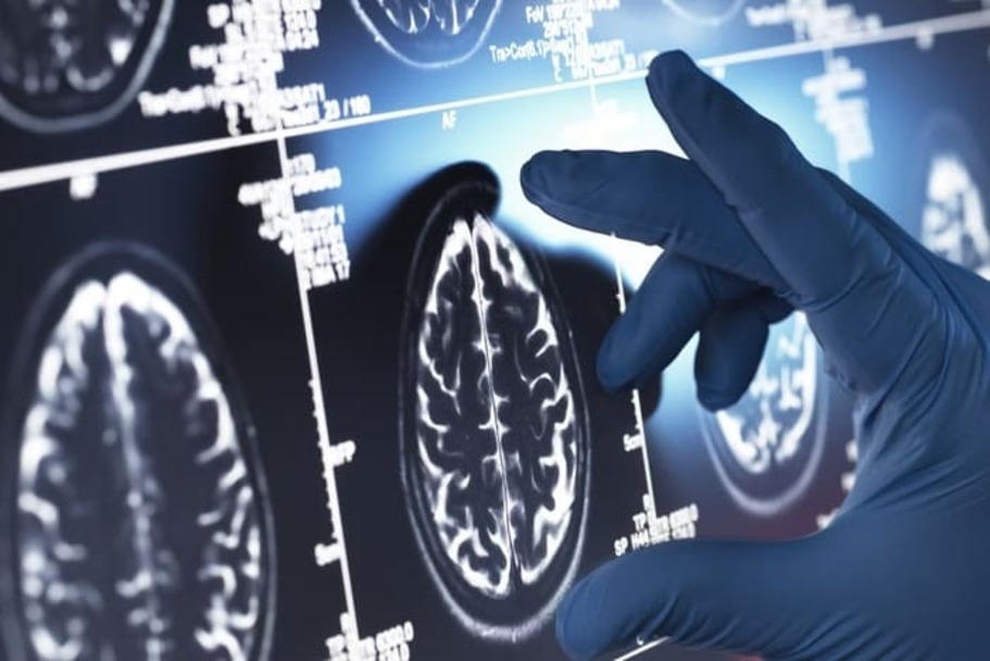 Anvisa Aprova Kisunla, Medicamento Inédito para Tratamento do Alzheimer 1 image 2025 04 23T115229.388 1
