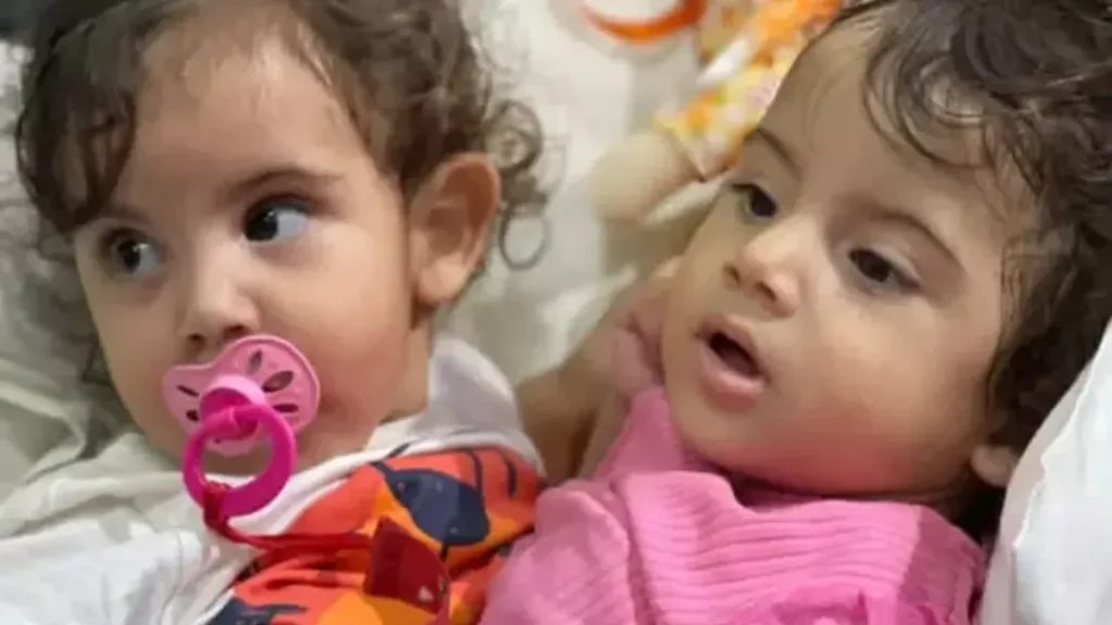 Siamesa Separada Está Sob Protocolo de Morte Encefálica 8 Protocolo morte encefálica siamesa