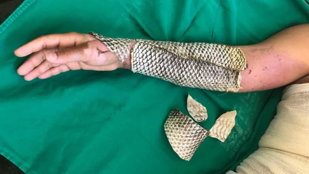 Brasil terá fábrica de pele de tilápia para tratar queimaduras 9 Brasil terá fábrica de pele de tilápia para tratar queimaduras