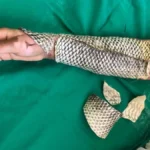 Brasil terá fábrica de pele de tilápia para tratar queimaduras